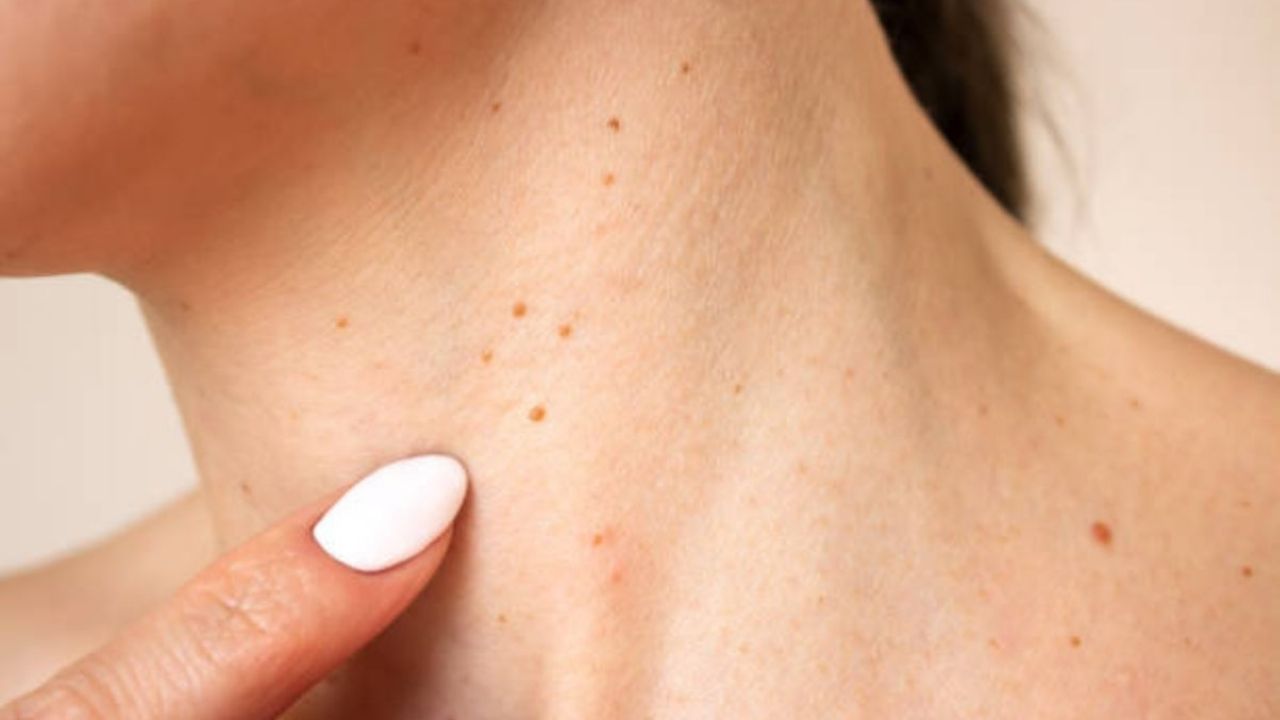 Beyond HPV: Unexpected Factors Behind Warts on Your Neck