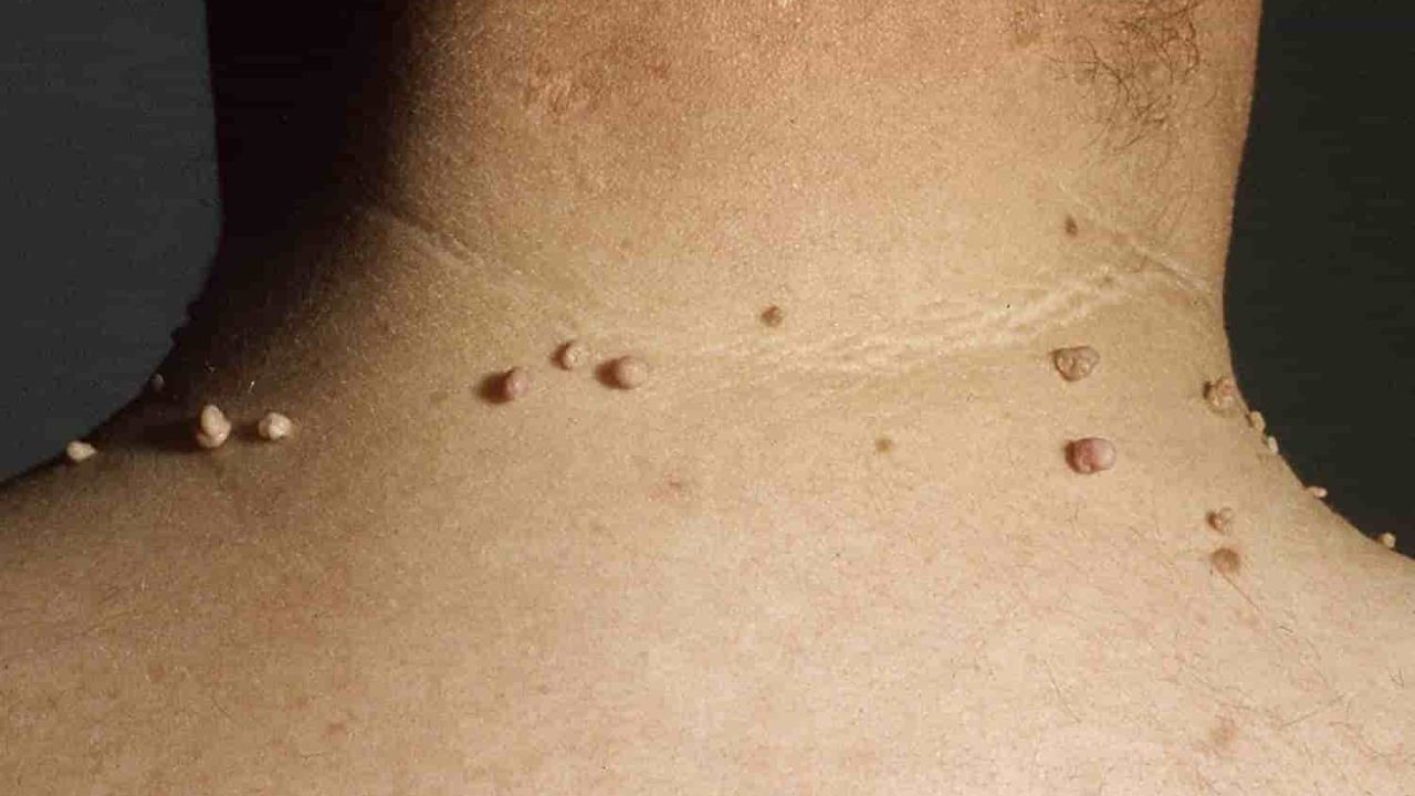 Neck Warts: How Diabetes, Hormones & Friction Contribute